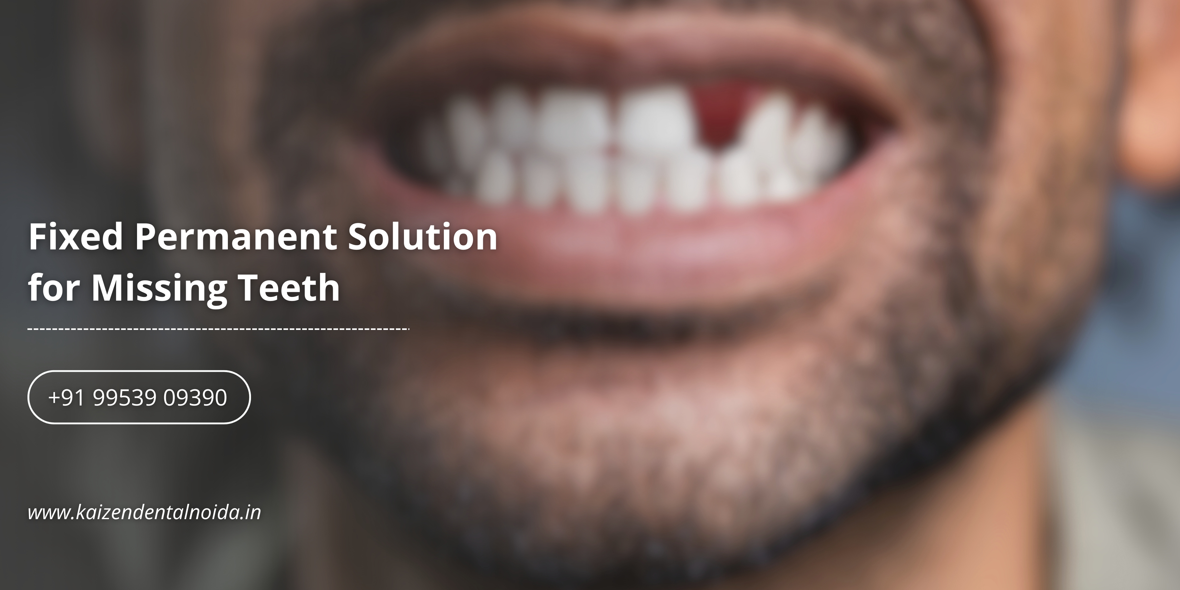 Kaizen-Dental-implant-procedure-restoring-natural-smile-with-permanent-titanium-tooth-replacement-in-modern-dental-clinic
